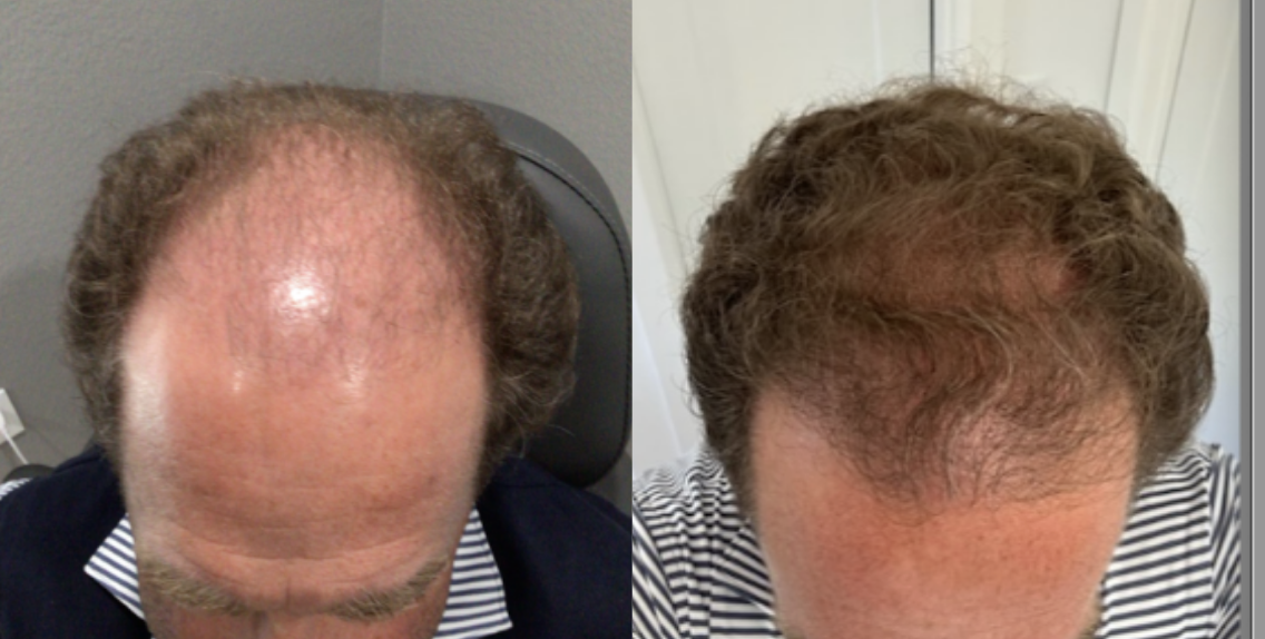 Before and After Results